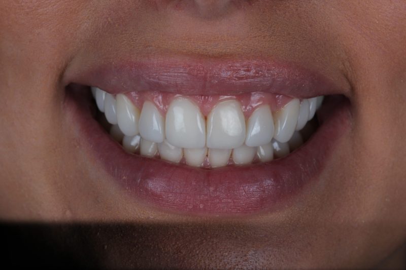 IMG_3348 After - Cheadle Hulme Dental