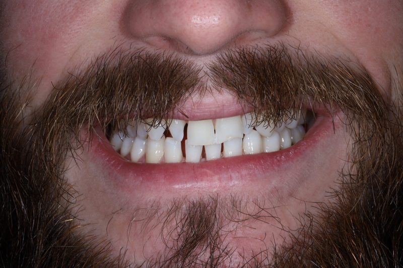 IMG_4659 Before - Cheadle Hulme Dental