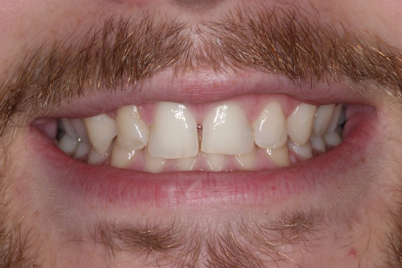 IMG_6700 Before - Cheadle Hulme Dental