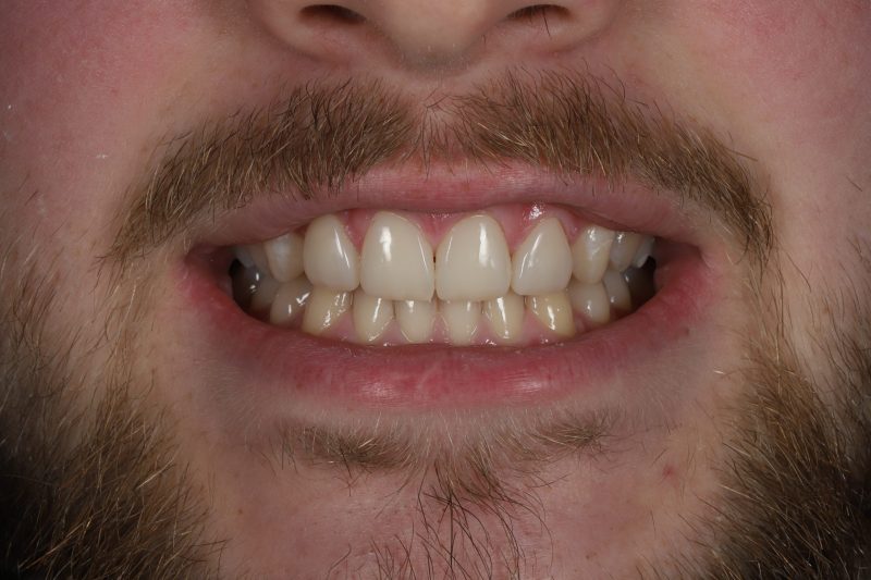 IMG_6737 After - Cheadle Hulme Dental