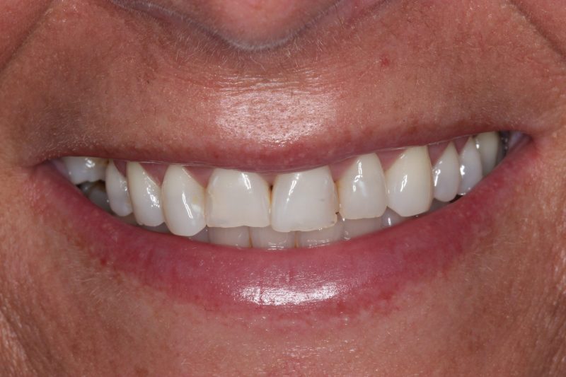 IMG_6960 Before - Cheadle Hulme Dental