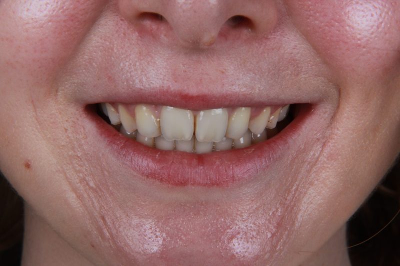 IMG_8469 Before - Cheadle Hulme Dental