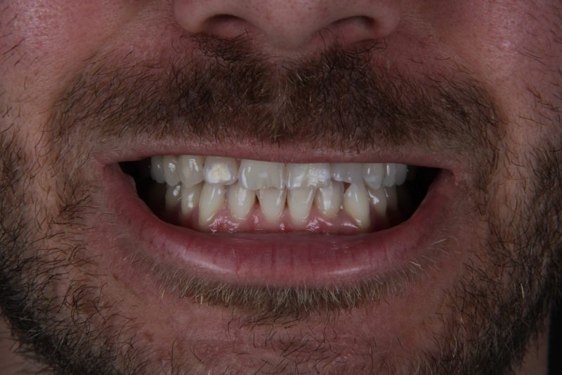 IMG_8543 Before - Cheadle Hulme Dental