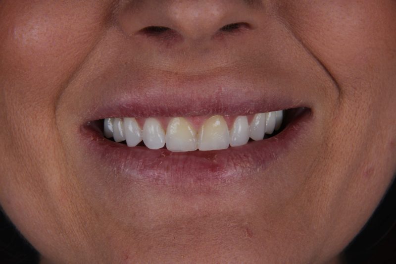 IMG_9066 Before - Cheadle Hulme Dental