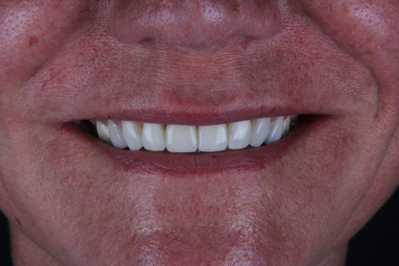 IMG_9077 After - Cheadle Hulme Dental
