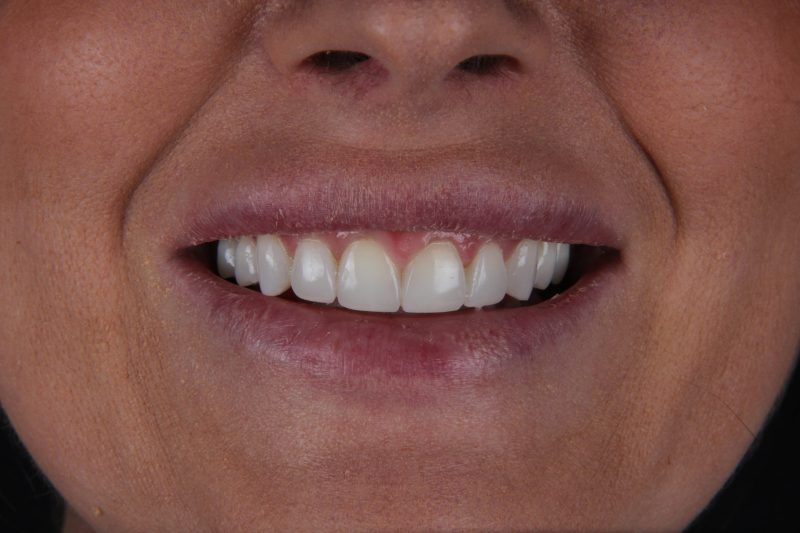 IMG_9246 After - Cheadle Hulme Dental
