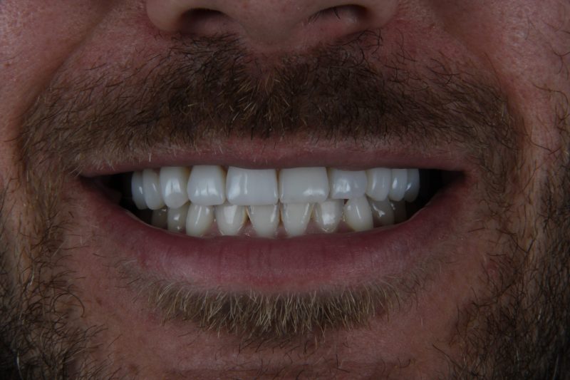 IMG_9287 After - Cheadle Hulme Dental