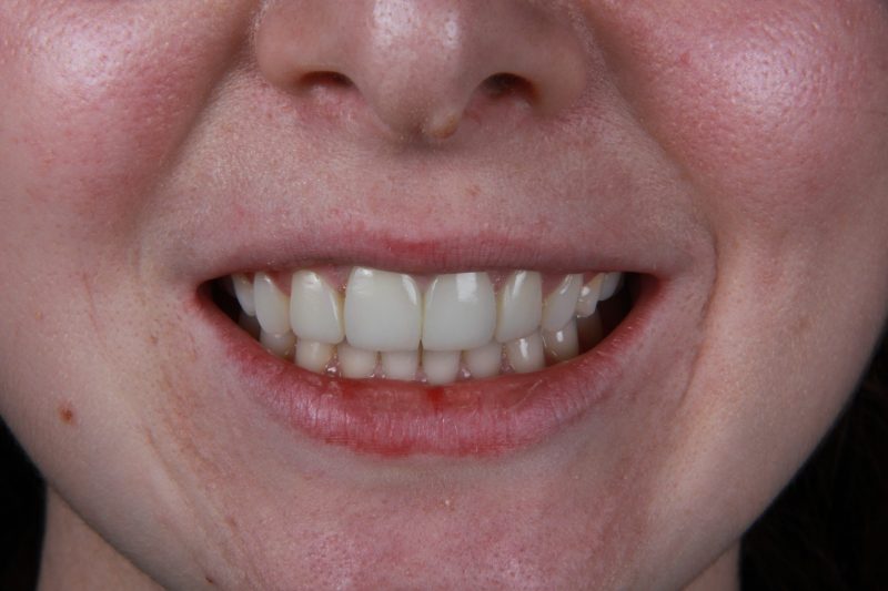 IMG_9295 After - Cheadle Hulme Dental