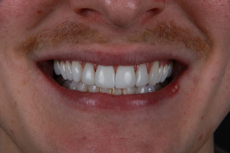 IMG_9342 After - Cheadle Hulme Dental