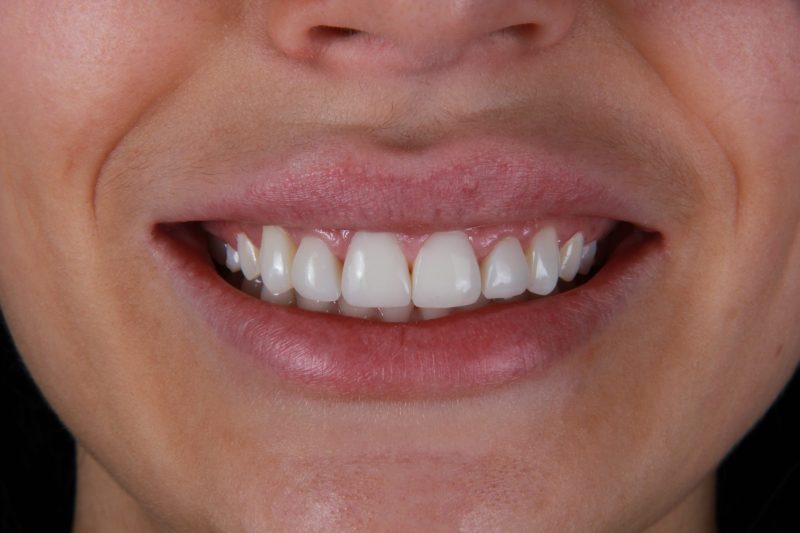 IMG_9386 After - Cheadle Hulme Dental