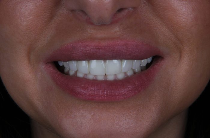 After - Cheadle Hulme Dental