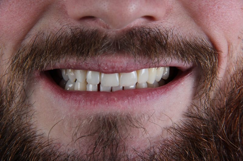 IMG_9666 After - Cheadle Hulme Dental