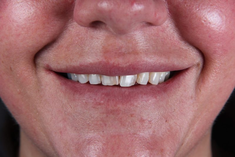 IMG_9716 Before - Cheadle Hulme Dental
