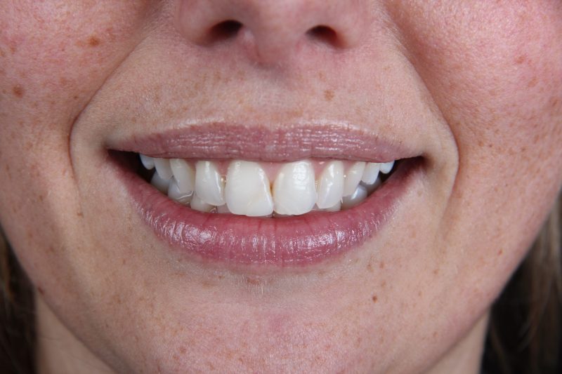 IMG_9725 Before - Cheadle Hulme Dental
