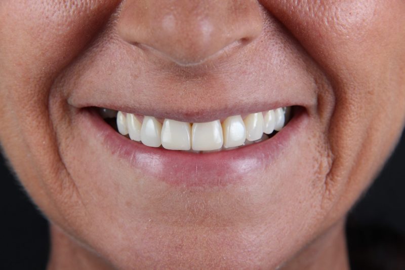 IMG_9736 After - Cheadle Hulme Dental