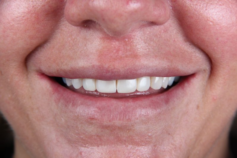 IMG_9774 After - Cheadle Hulme Dental