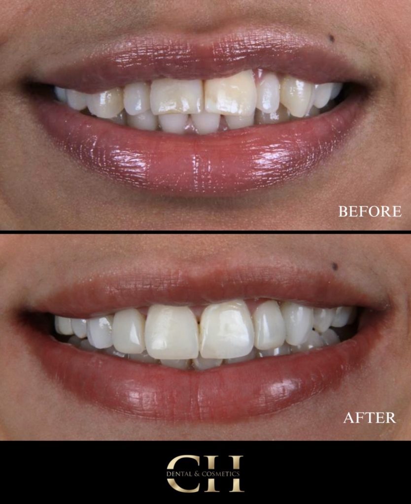 natural smile makeover in manchester