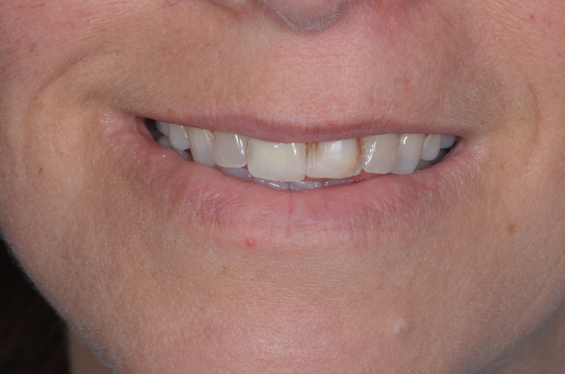 Before 3D printed veneers