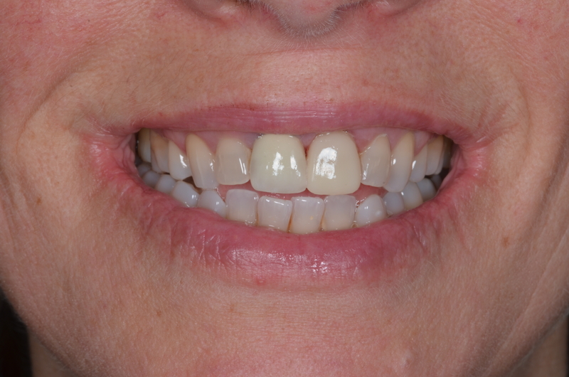 After 3D printed veneers